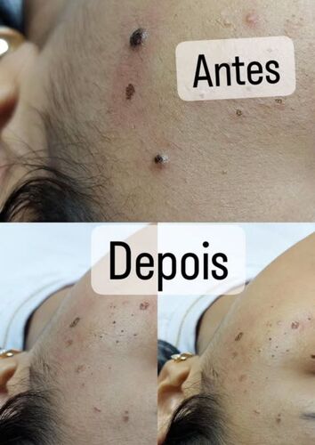 Antes e depois